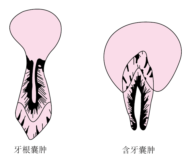 上颌窦牙源性囊肿