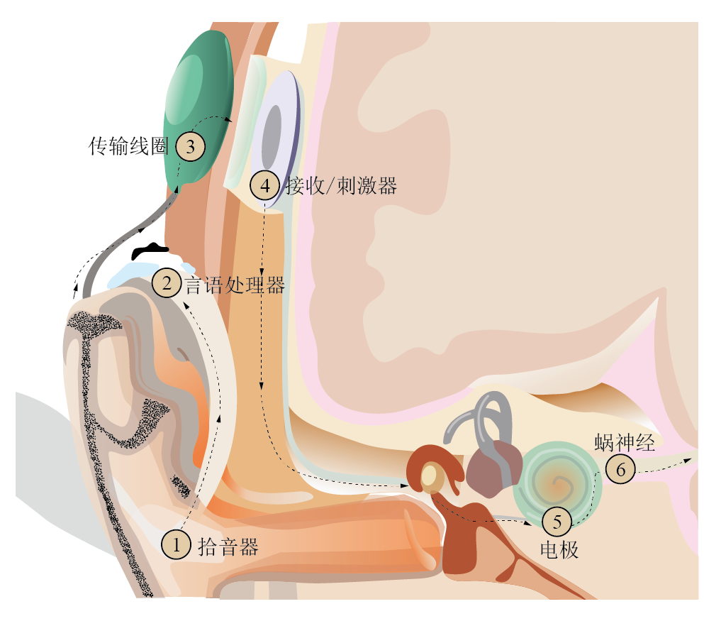 人工耳蜗