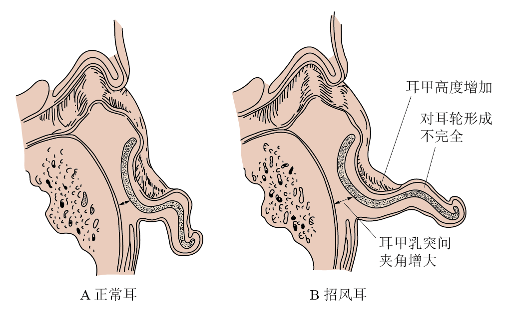 正常耳与招风耳的对比